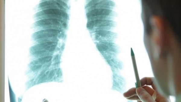 Chuẩn đoán ung thư phổi